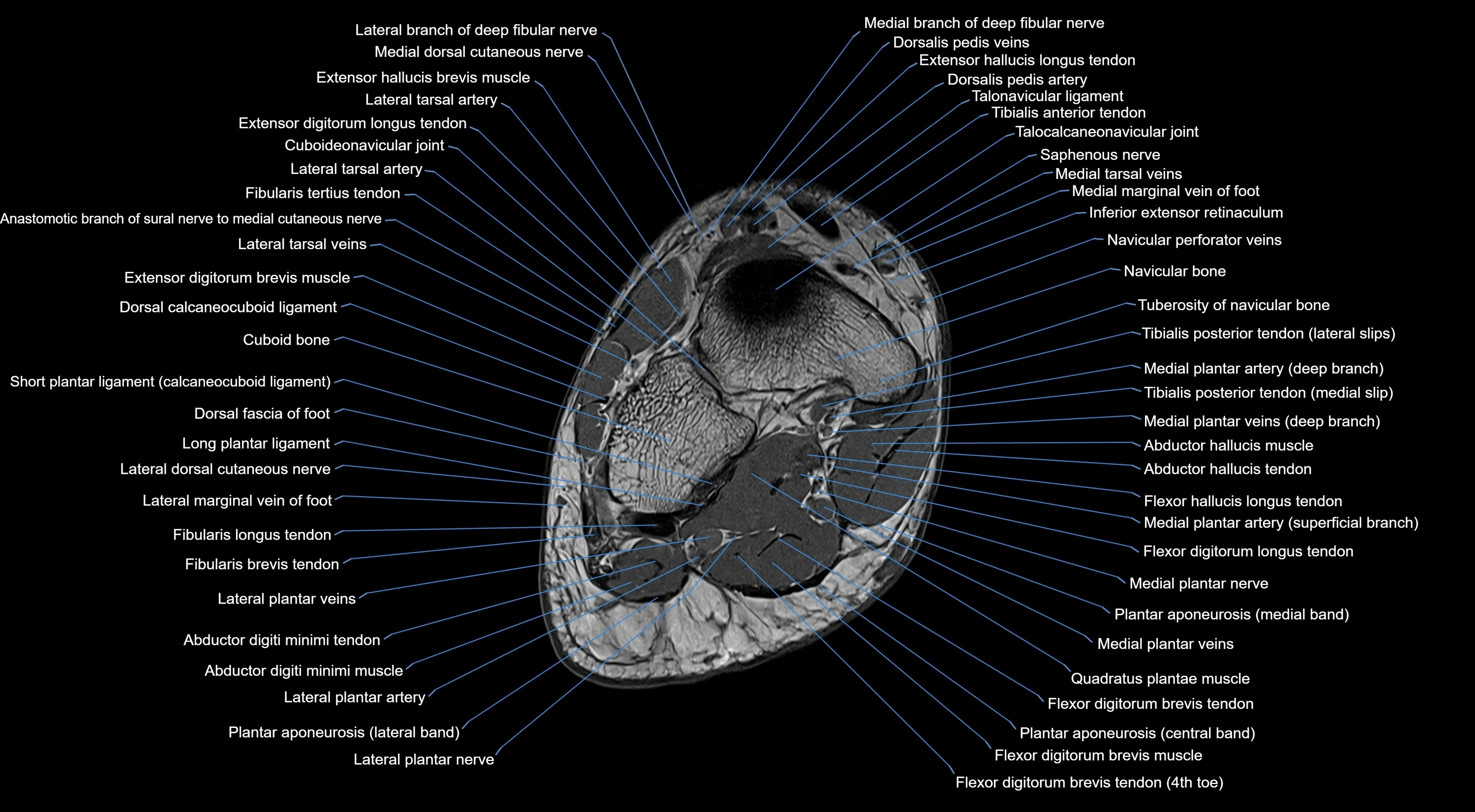 MRI mid foot coronal ligaments cross sectional anatomy 3T  radiology  image-img-00001-00031.webp